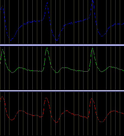Example of the multipoint pulse program